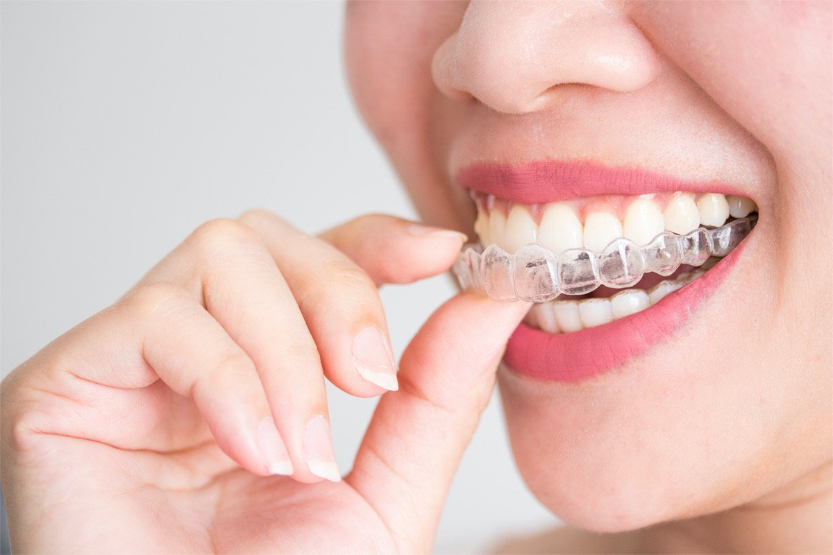 INVISALIGN MUMBAI