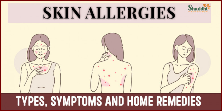 Skin Allergies : Types, Symptoms and Home Remedies