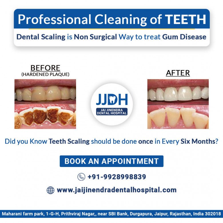 Dental Scaling