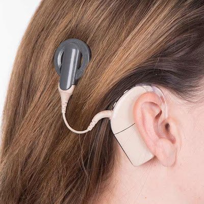 Cochlear Implants Market Continues To Grow With Cochlear Ltd. Receiving The U.S. FDA Approval For Three New Hearing Devices