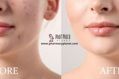 4 Stages of Acne and its Treatment - Pharmacy Planet
