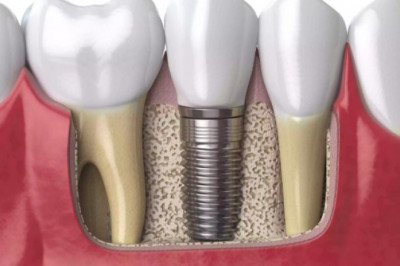 Dental Implant Procedure
