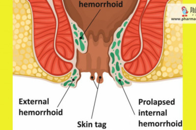 The Difference Between a Haemorrhoid and Skin Tag