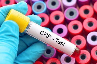 Dengue NS1 Antigen Test, EIA in Delhi- Redcliffe Labs
