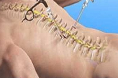 Global Spine Surgery Devices Market Report by size, regional expansion strategies, research &amp; development, and forecast 2028