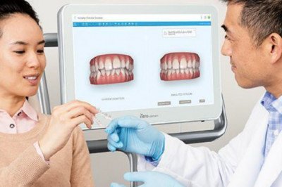 4 Steps to Unlock the Perfect Smile with the Help of Clear Aligners!