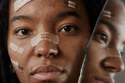 Do Hydrocolloid Bandage Work for Acne – Things You Should Know