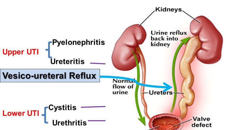 Urinary Tract Infections Treatment Can Be Evaluated From The Viewpoint Of Healthcare Costs