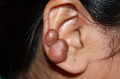 Types Of Scars and Causes - Prof Dr. Robert Hierner