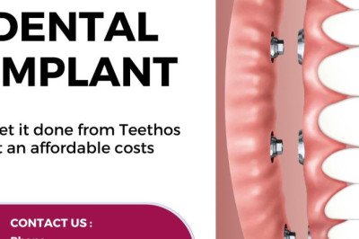 Where can you find The Best DENTAL IMPLANTS COST IN KOCHI?