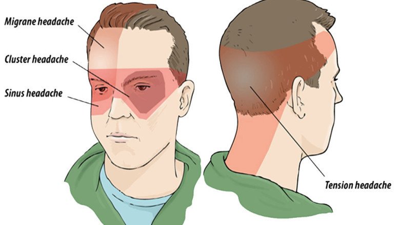 Let’s Know About the Symptoms of Cluster Headaches