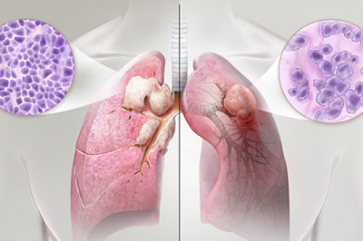 Non-Small Cell Lung Cancer Market Overview Analysis, Growth Factor and Forecast to 2030