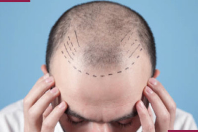Best hair transplant surgeon in Hyderabad